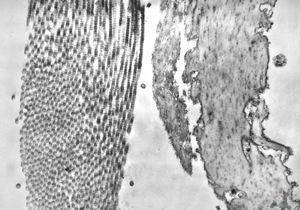 F, 39y. | collagenous and elastin fibers from corium F, 39y. | collagenous and elastin fibers from corium